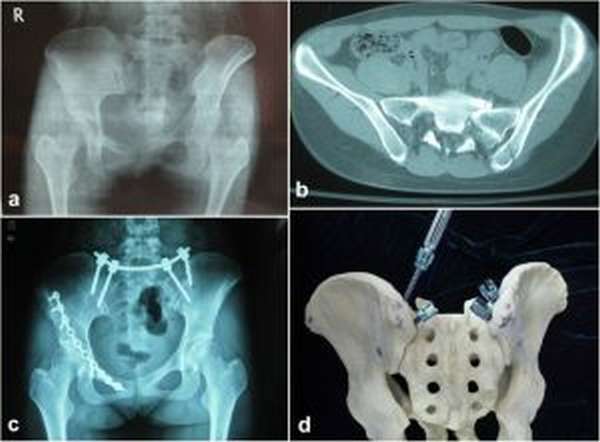 Оперативное вмешательство при переломе костей таза